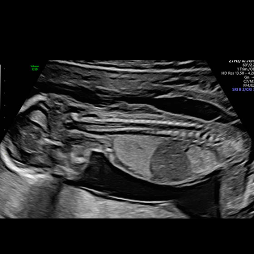 Fetal Anamoly Scan in Kolkata