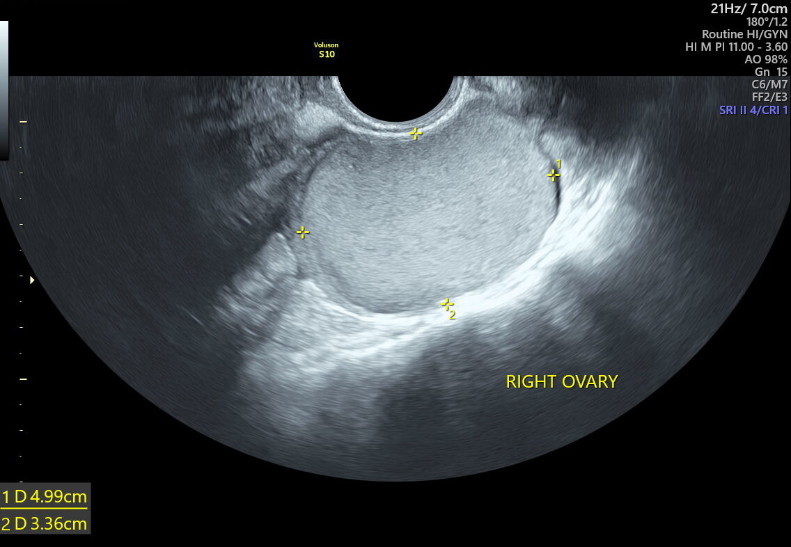 ENDOMETRIOTIC CYSTS.4dv_6 (1)
