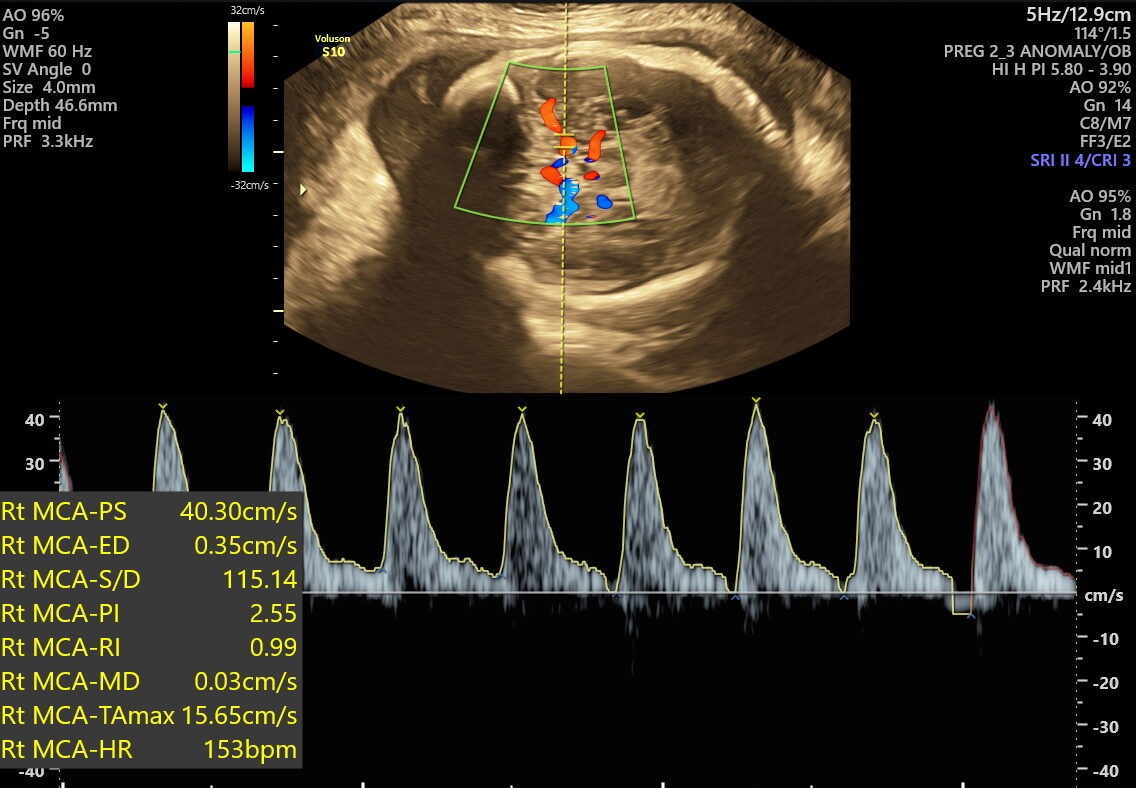 FETAL GROWTH AND WELLBEING SCAN